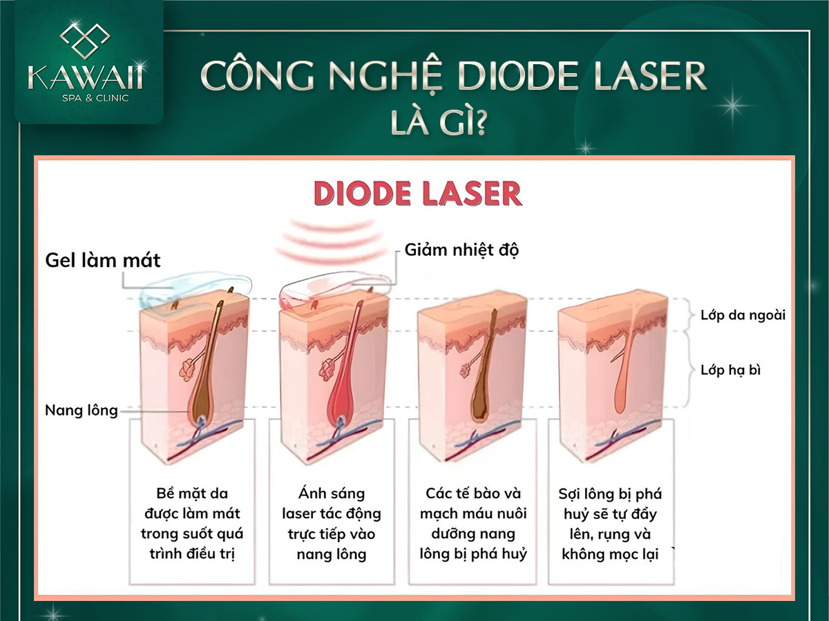 Diode Laser triệt lông