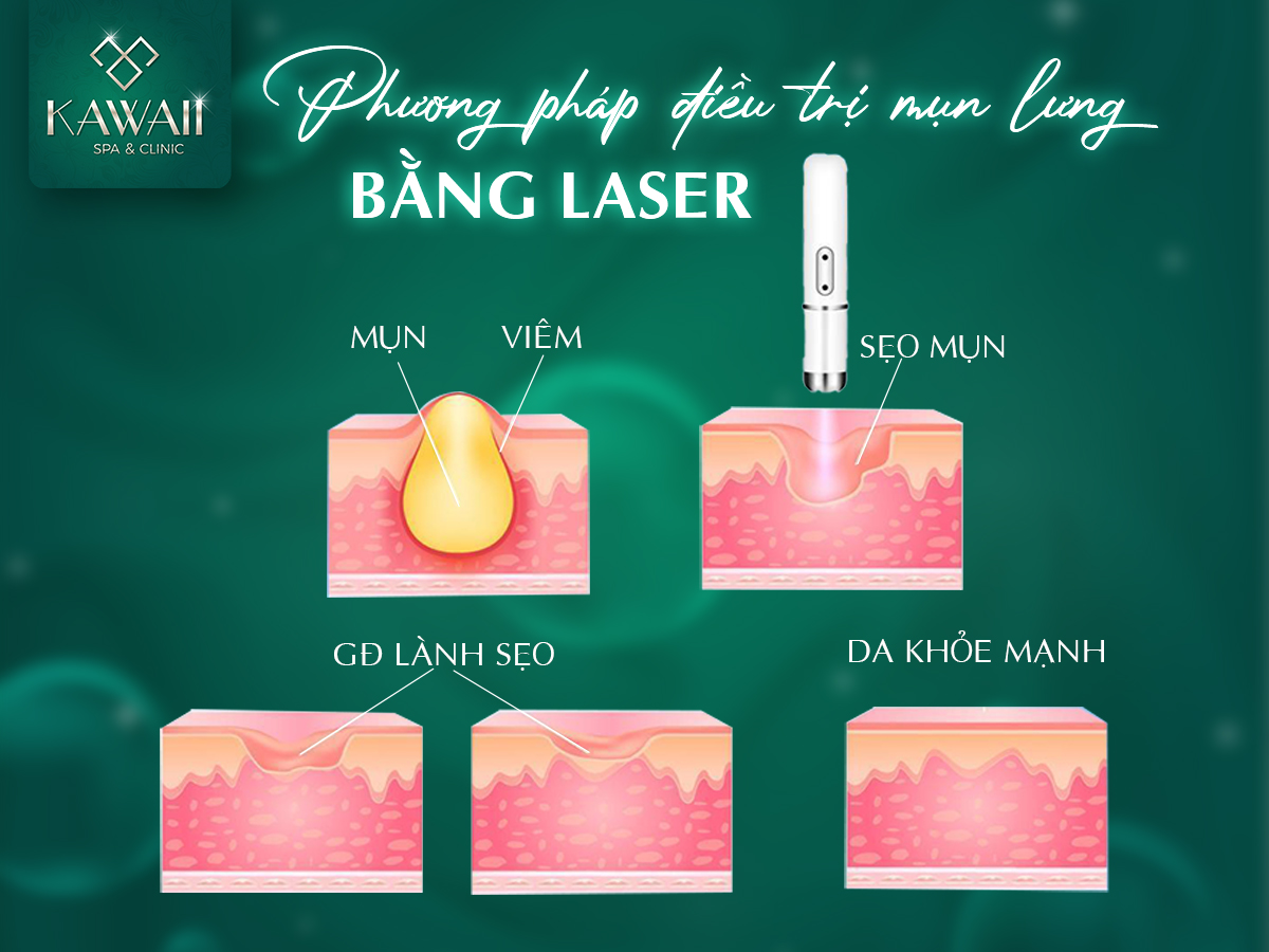 phương phoáp điều trị mụn lưng bằng laser