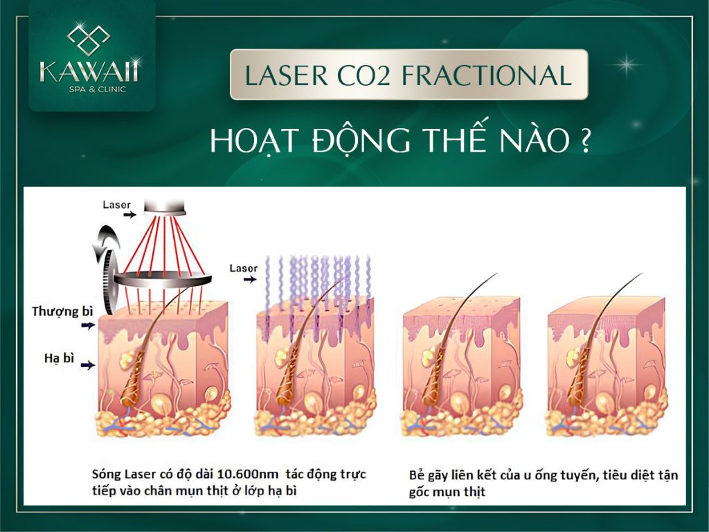 laser co2 fractional có hiệu quả không